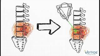 Robotic Spine Surgery: What Mazor X™ Actually Does — and What It Doesn’t | Dr. Kamal Woods