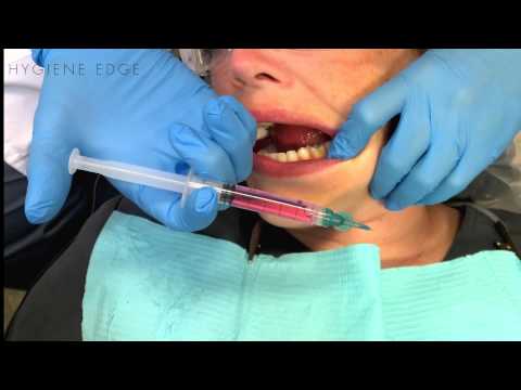 Video: Dental Og Periodontal Kortlægning: Formål Og Procedure