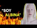 VIVIR SIENDO ALBINA (Entrevista a Ana Trujillo)