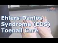 Ehlers-Danlos syndrome (EDS) and Toenail Care 👩🏻⚕️🦶👣🦵🚶🏃