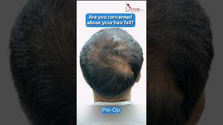 Gfc For Hair Loss Treatment Growth Factor Concentrate Therapy
