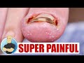 12YR OLD SUFFERING FROM A PAINFUL INFECTED INGROWN TOENAIL!!!