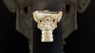 See The Misalignment On Cbct Advanced Spinal Imaging Upper Cervical Care
