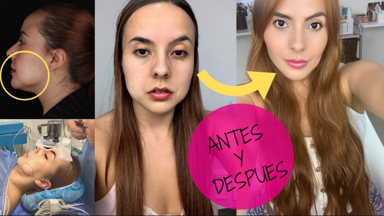 Mi Experiencia Con La Marcacion Facial Bichectomia Y Lipopapada Karomakeup Youtube
