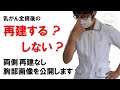 乳がん全摘後再建する？しない？再建しなかった私のメリットとデメリット