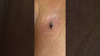 Big Blackhead Removal oddlysatisfying sick blackhead pimplepopper satisfying cyst omg wow