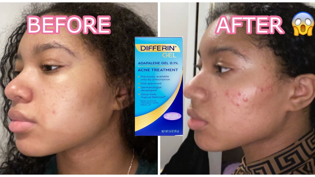 Differin Gel RUINED My Skin 😭👎🏽