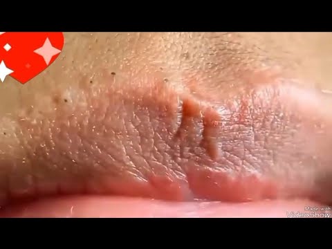  إزالة الرؤوس السوداء والزيوان حول الفم سكينكير