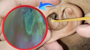 Deep Earwax Removal | Impacted Wax & Infected Ear Cleaning ASMR | EP 190
