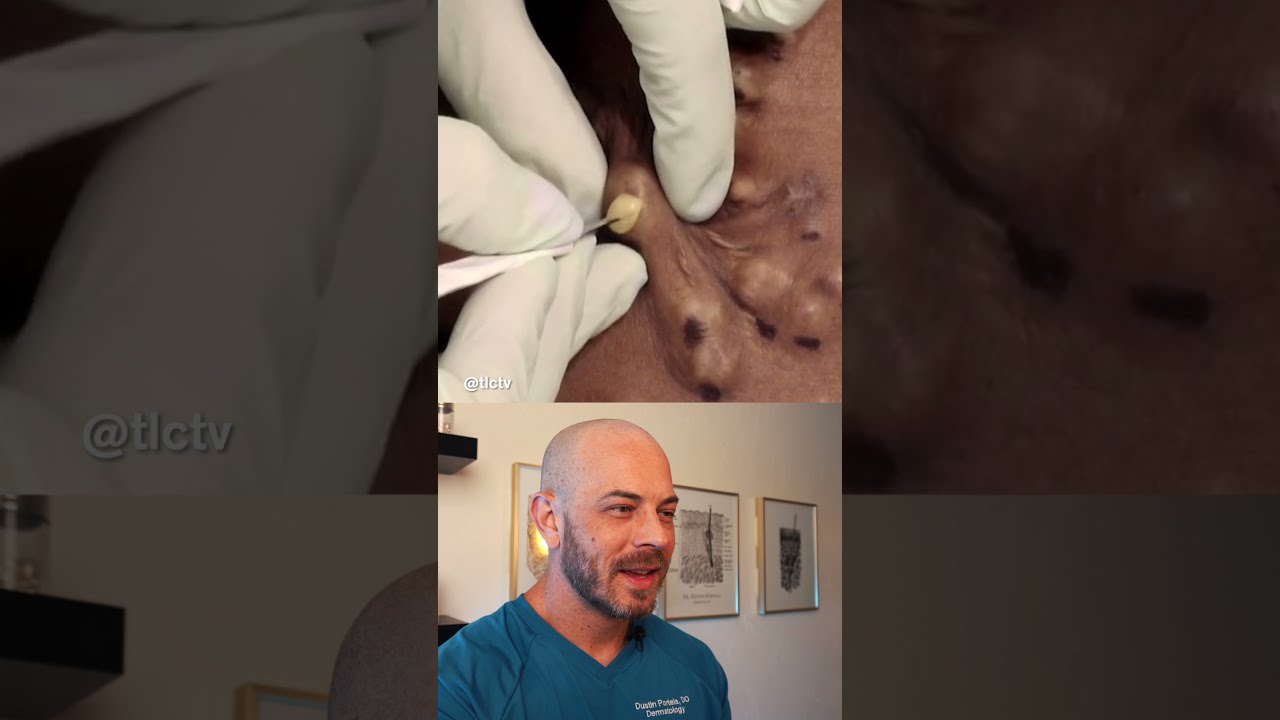 Derm Reacts To Buttery Pimple Pops Dermreacts Doctorreacts Butterypimplepop