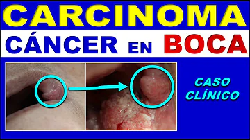 ¿Qué aspecto tiene el carcinoma de células escamosas en la boca?