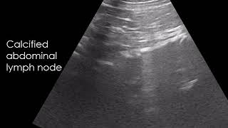 CASE 707 Calcified abdominal lymph node