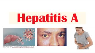 Hepatitis A  | Virus, Risk Factors, Pathophysiology, Signs \& Symptoms, Diagnosis, Treatment