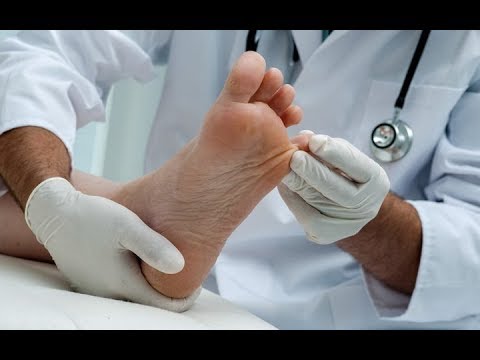 Wideo: Jak Odróżnić Posiniaczony Mały Palec U Nogi Od Złamania: Porada Lekarza