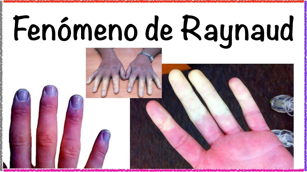 Fenómeno de Raynaud YouTube
