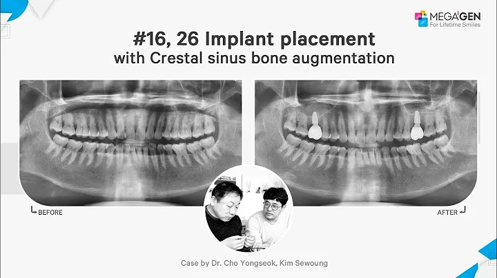 Dr. Yongseok CHO, Sewoung KIM, #16,26 implant with...