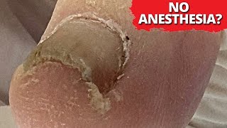 No Anesthesia?! 🤯 DEEP Ingrown Nail Removal