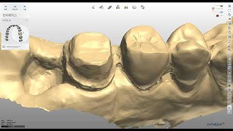 [치과&치과기공실](3shape)트리오스 모델리스 26번 싱글 크라운 제작.