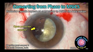 CataractCoach™ 1919: convert from phaco to MSICS for posterior capsule rupture