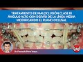 Manejo del plano oclusal en un caso de clase III esquelética