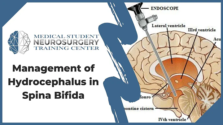 Management of Hydrocephalus in Spina Bifida