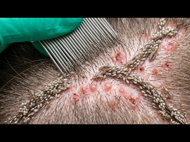 The Best Ways to Care for Your Hair to Avoid Head Lice #part56