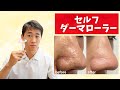 【完全版】セルフダーマローラーの効果と使い方