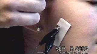 EMG Wire Placement