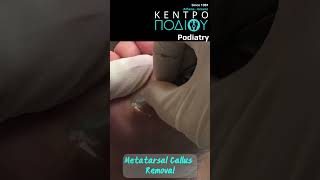 Callus removal #foot #footcare #podologos #athlete  #calluses #feet #footpain #athlete #podiatrist