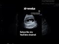 #baby #pregnancyscan #mom #pregnancyultrasound #love 10 weeks pregnant baby heart rate ##