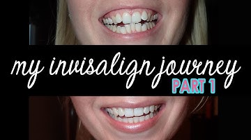 My Invisalign Journey PART 1  |  Get Straight Teeth With Invisible Braces! Invisalign Cost & Process