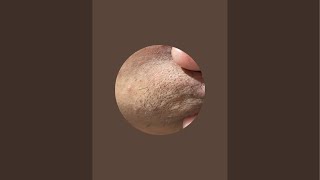Ingrown hairs zone .6 is live\#ingrownhair #oddlysatisfying #oddlysatisfyingvideo #satisfying #asmr