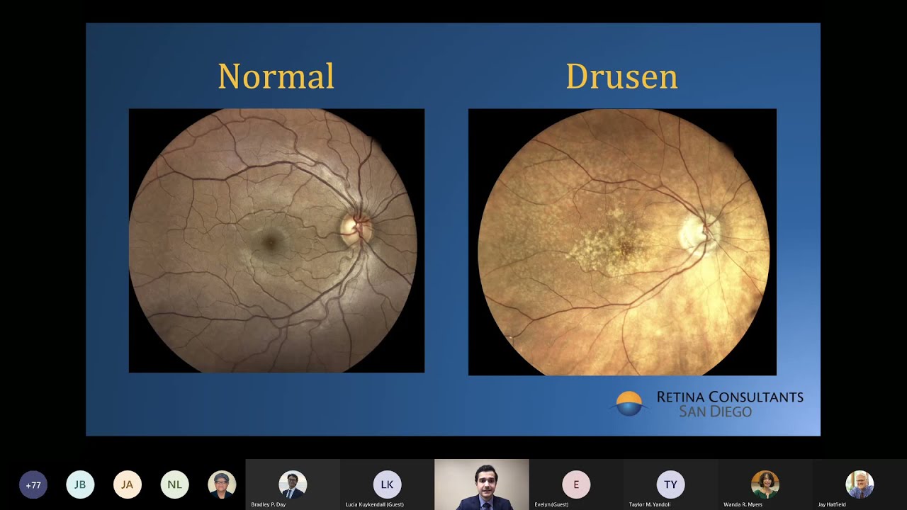 Macular Degeneration and the Latest Research - Low Vision Month 2022