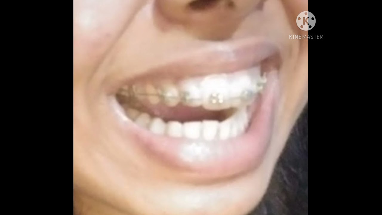 Braces time lapse//6months braces lapse//braces journey//everything about braces YouTube
