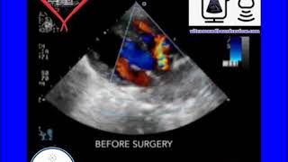 Ultrasound Board Review on Rastelli Palliative Procedure