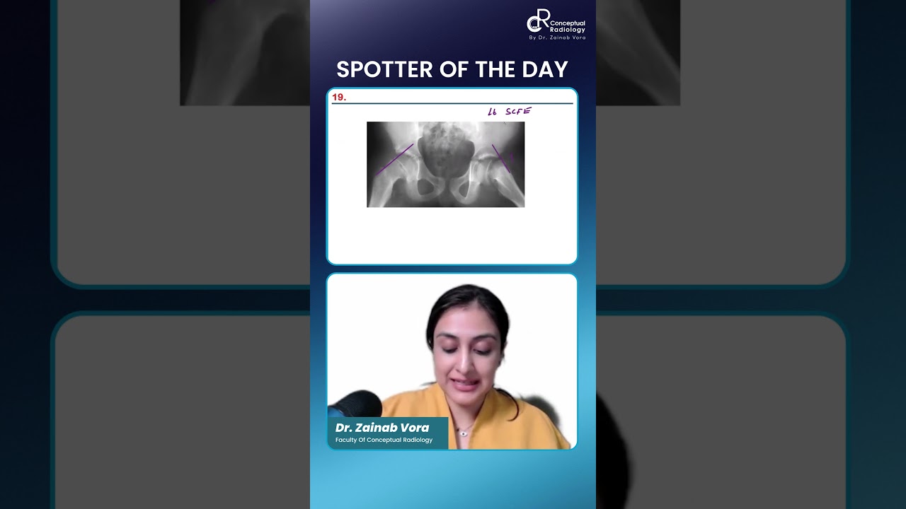 Spotter of the Day by Dr. Zainab Vora | Conceptual Radiology | Radioogy Residency 