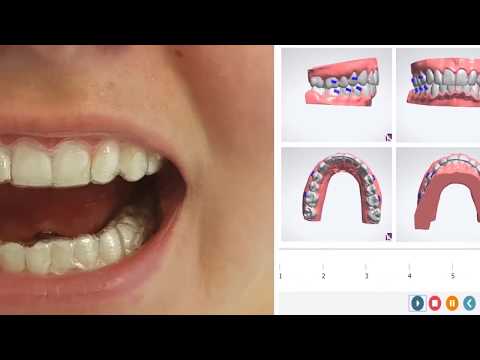 Video: Dantų Išlyginimas: Petnešų Uždėjimas