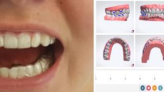 Dantų Tiesinimas Su Nematomomis K Line Kapomis