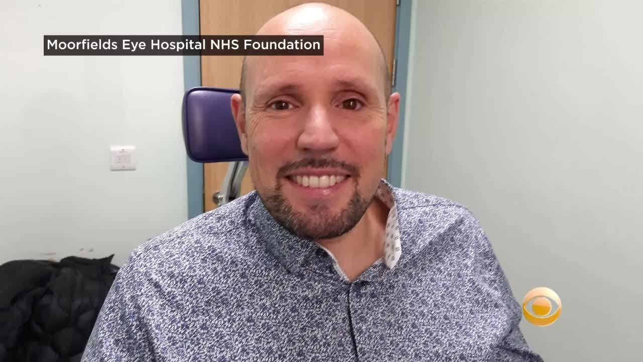 Man Who Received World’s First 3D Printed Prosthetic Eye Says It ‘Looks Fantastic’