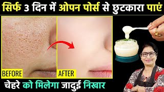 चेहरे से पिंपल्स, दाग धब्बे, मुंहासे, Open Pores को सिर्फ 3 दिन में 100% हटाए | Skin Whitening Cream