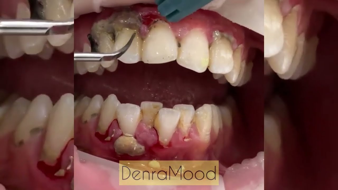 Teeth cleaning. Cleaning teeth stones. Good work. YouTube