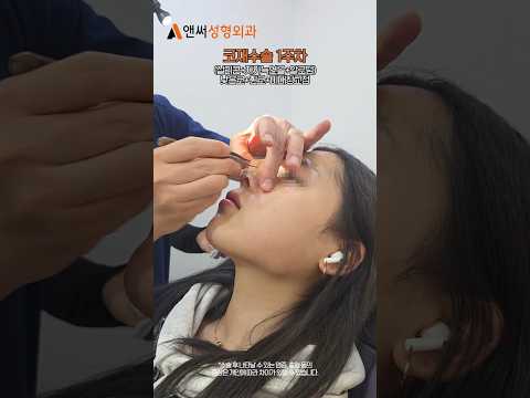 코재수술 낮은코+휜코+비대칭교정 1주 부목제거 전후 👃