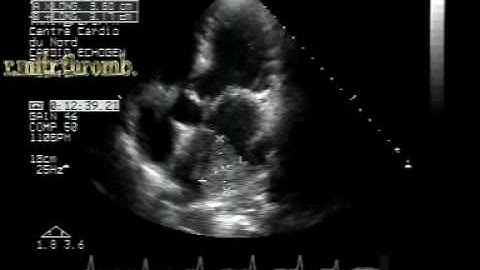 MS different aspects:mitral stenosis with LA thrombus2