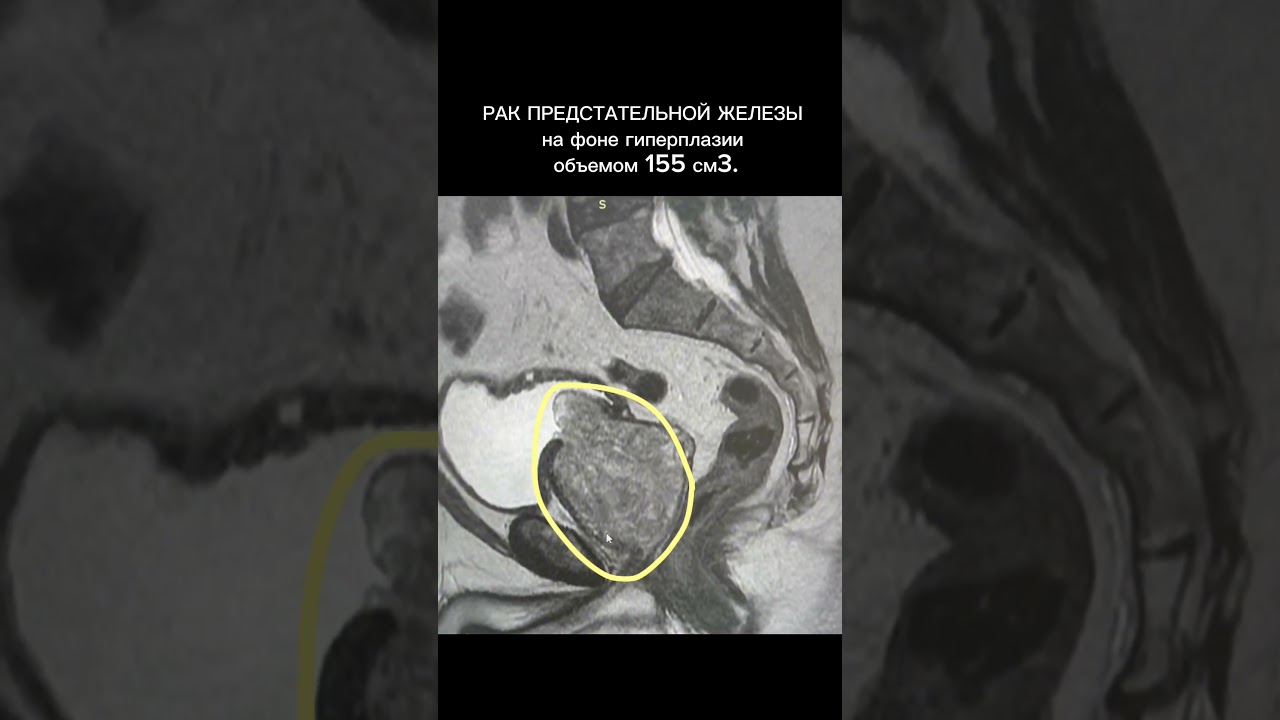Рак предстательной железы. МРТ малого таза