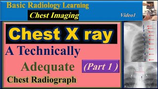 Chest X ray, A Technically Adequate Chest Radio graph- Part1