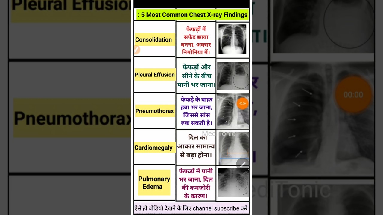 Chest का X ray कैसे देखते है - Chest X Ray report