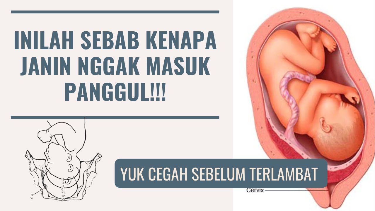 PENYEBAB JANIN BELUM MASUK PANGGUL