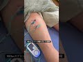 100mスプリンターの肉離れに対する電気鍼