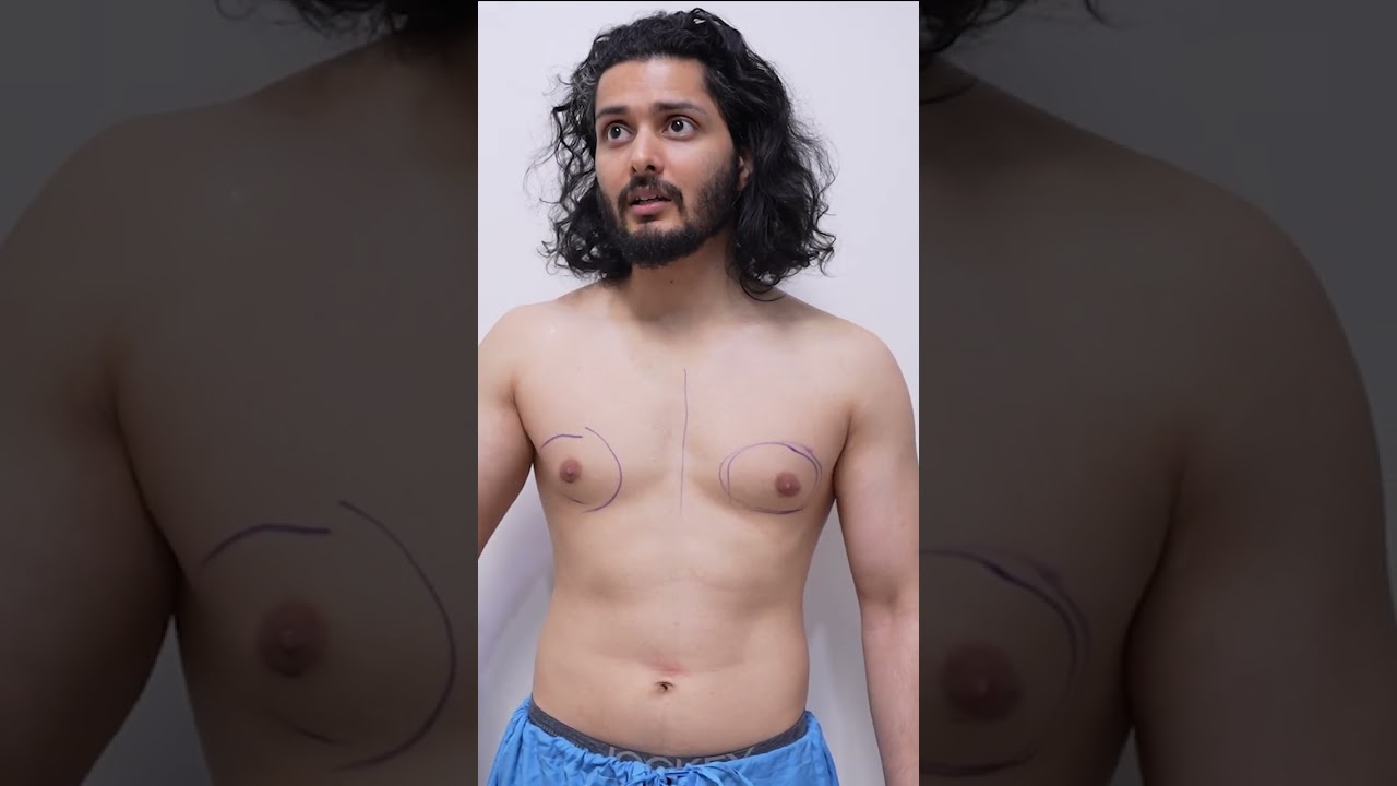 Gynecomastia | Gynecomastia Surgery | Gynecomastia Surgery cost #shortvideo #dezireclinicindia