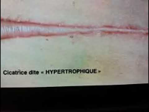 Crème Pour Excroissances, Cicatrices Hypertrophiques Et Chéloïdes - Vtmcompany - Neuf 31-50ml